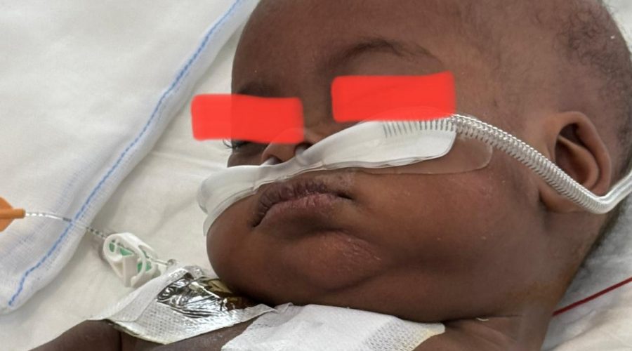 Dal Burundi a Taormina: la piccola Shama salvata dai medici del reparto di cardiochirurgia pediatrica