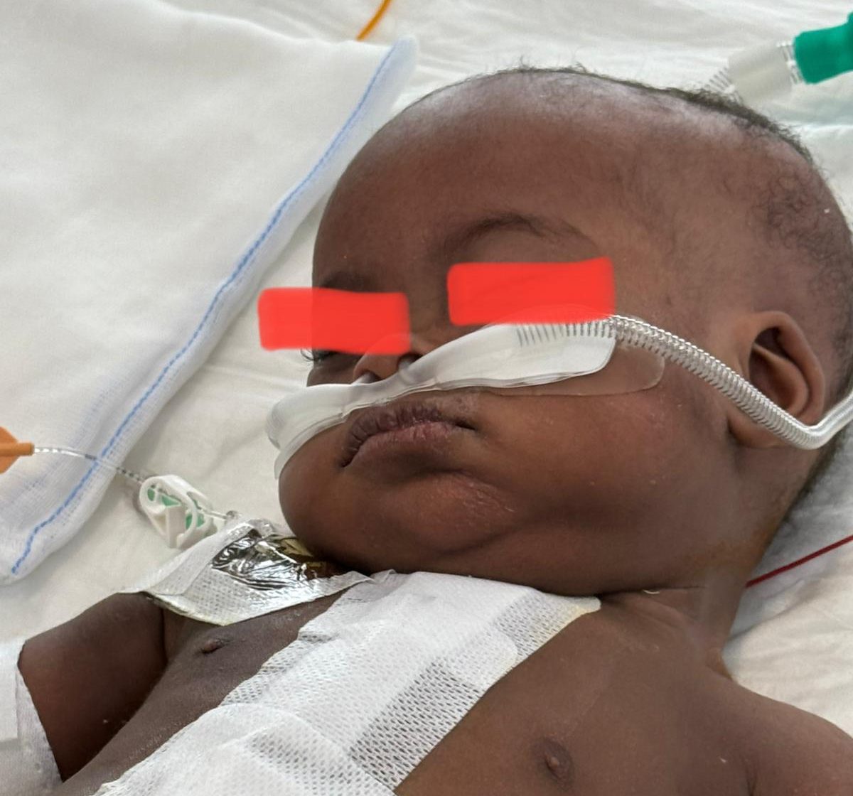 Dal Burundi a Taormina: la piccola Shama salvata dai medici del reparto di cardiochirurgia pediatrica