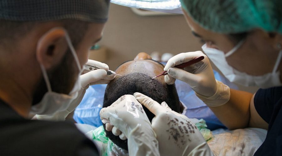 Il trapianto di capelli: vantaggi estetici e psicologici